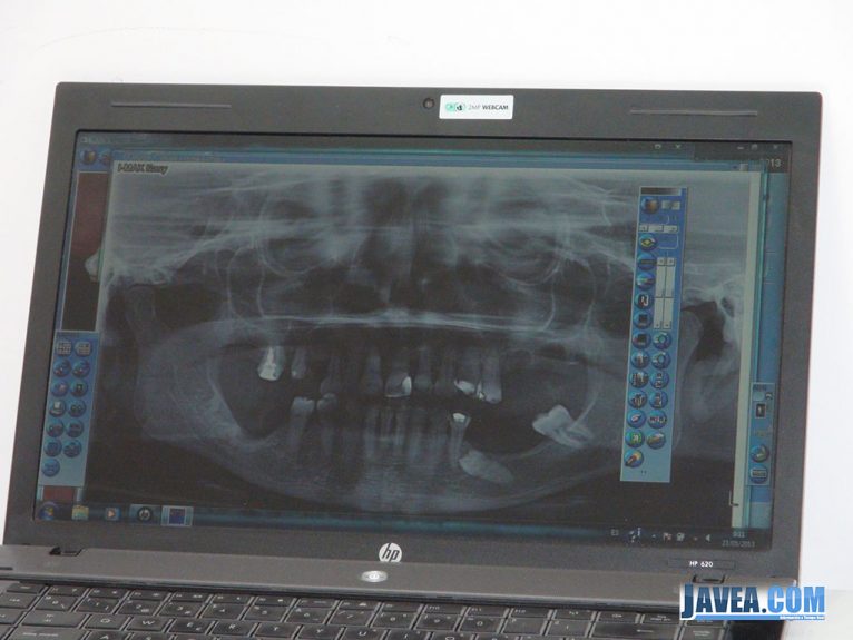 Clínica Dental Puchol Javea, radiografía dental digital