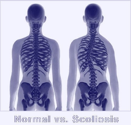 Escoliosis