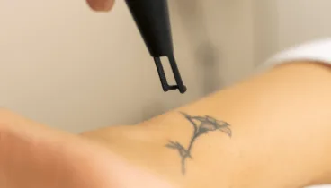 Borra los tatuajes que no te agradan o que con el tiempo se han deformado