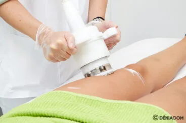 Cyclone celulitis en Dénia – Clínica Doctora Castelblanque