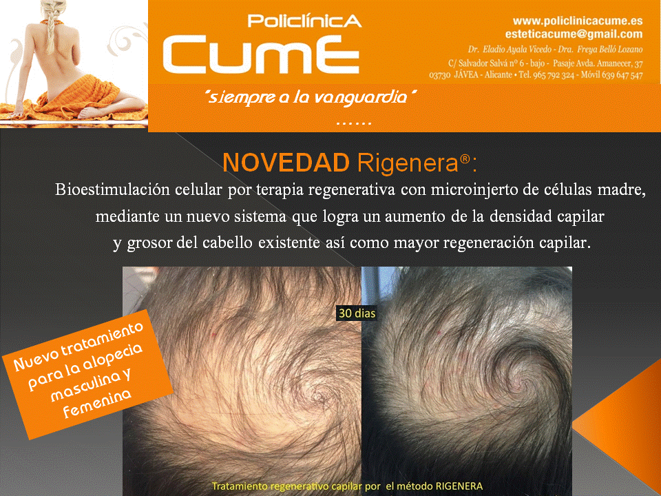 Alopecia Policlínica Cume