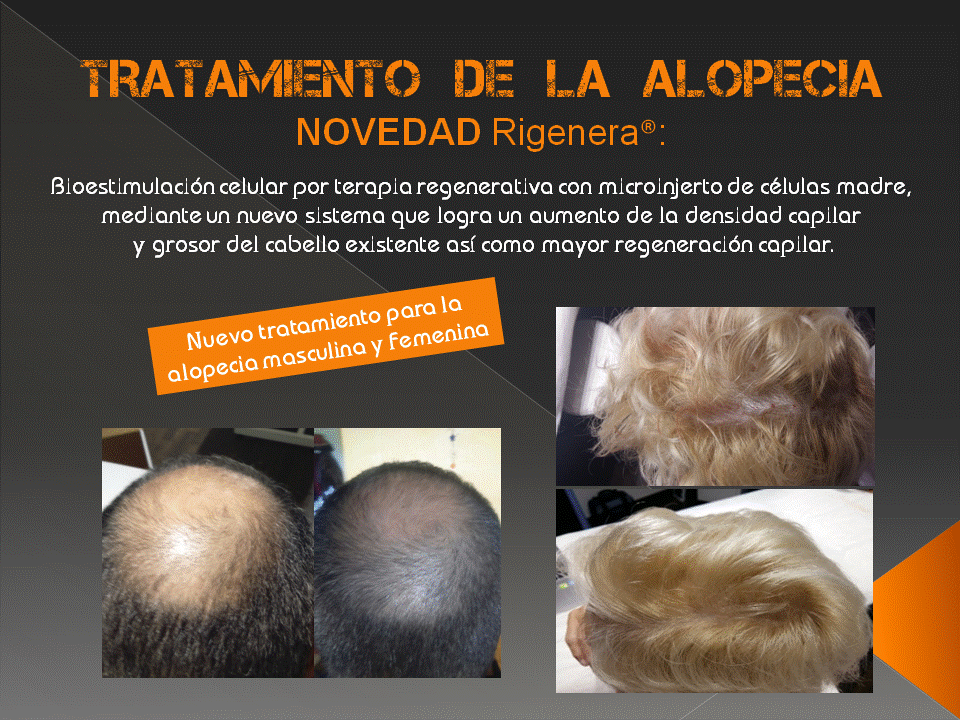 Tratamiento para la alopecia de Policlínica Cume
