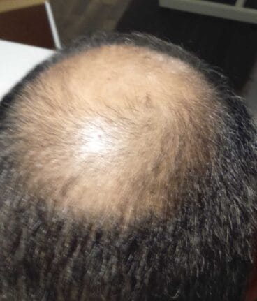 Tratamiento de la alopecia en Policlínica Cume