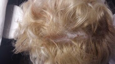 Tratamiento de la alopecia en Policlínica Cume