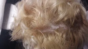 Tratamiento de la alopecia en Policlínica Cume