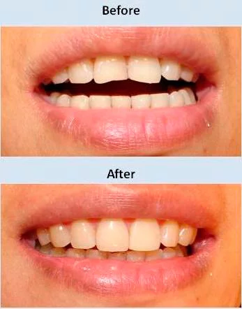 Antes y despues del tratamiento Clíncia Dental La Plaza