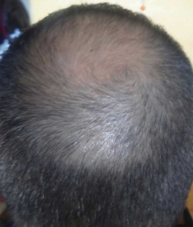 Tratamiento de la alopecia en Policlínica Cume