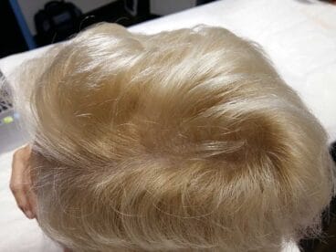 Tratamiento de la alopecia en Policlínica Cume