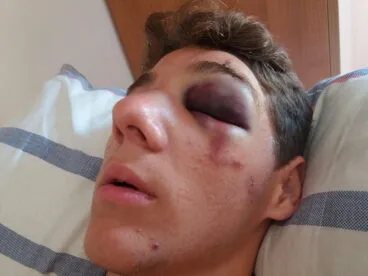 Alex está pendiente de la evolución del hematoma del ojo