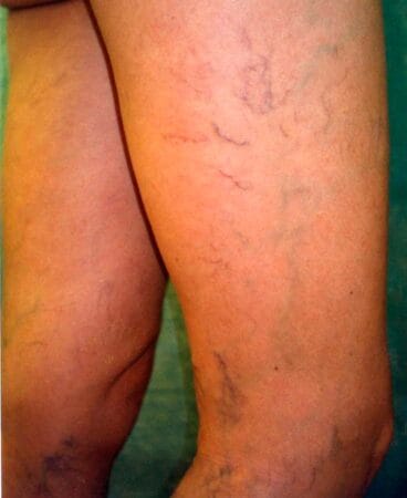 Varices Policlínica CUME