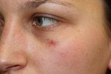 Antes del tratamiento-ellipse-clinica-castelblanque-590×393