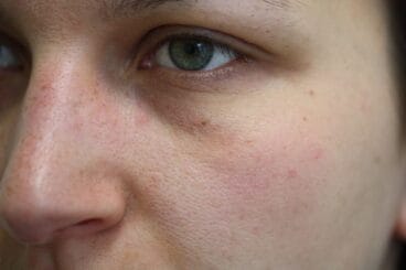 Después del tratamiento ellipse Clínica Castelblanque