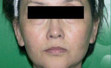 Eliminar rojeces clínica Castelblanque