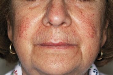 Telangiectasias antes cortesía de Simón Ellipse Castelblanque