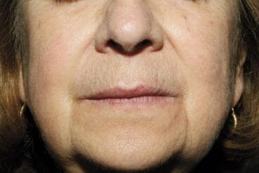 telangiectasias-cortesia-dr-simon-ellipse-clinica-castelblanque-590×394