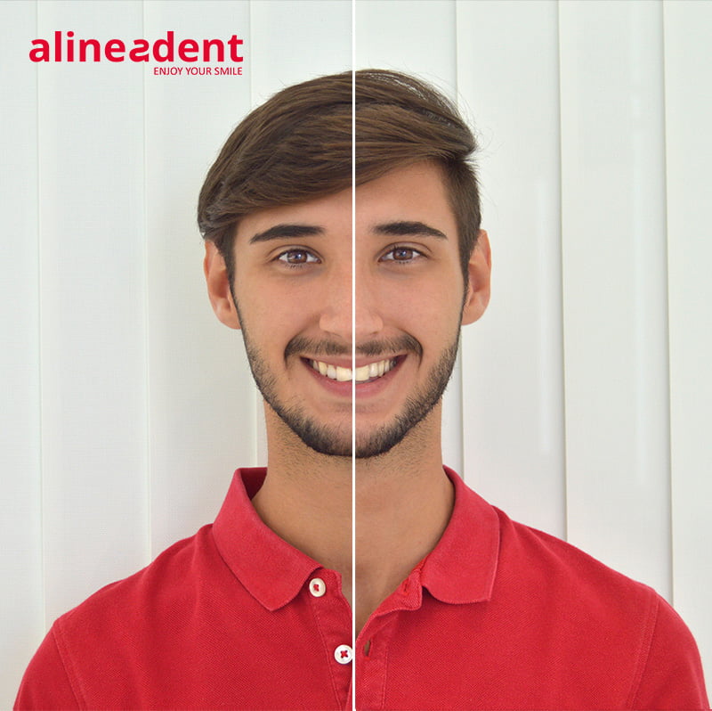 Alineadent antes y después Clínica Dental Puchol Jávea