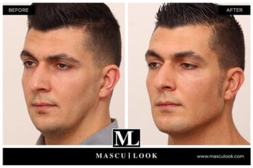 Mascu-look – Clínica Estética Castelblanque