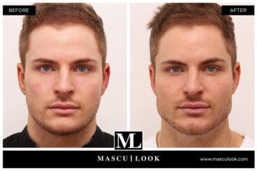 Tratamiento Ácido Hialurónico – Clínica Estética Castelblanque