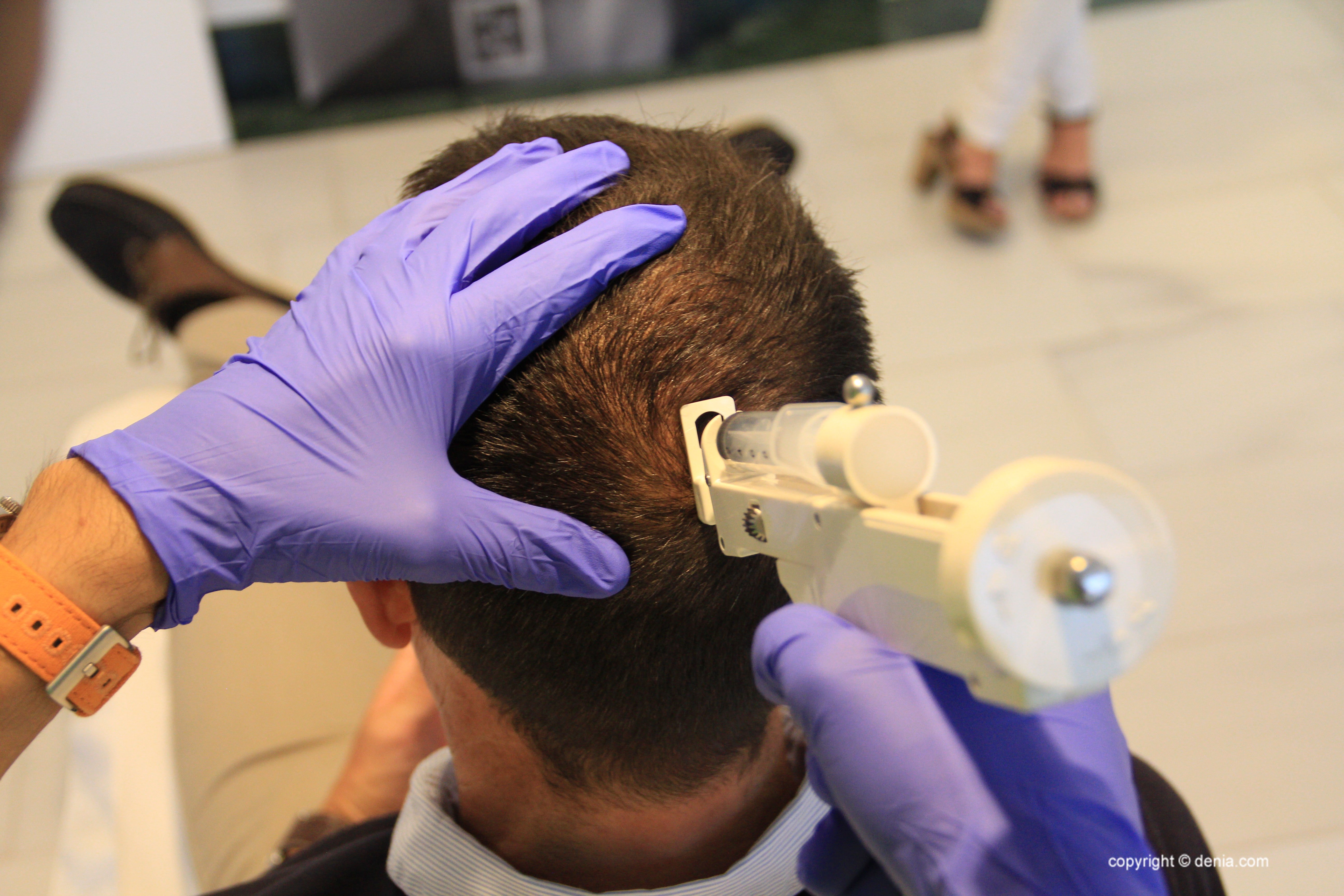 Imagen: Tratamientos capilares en Dénia - Clínica Estética Castelblanque