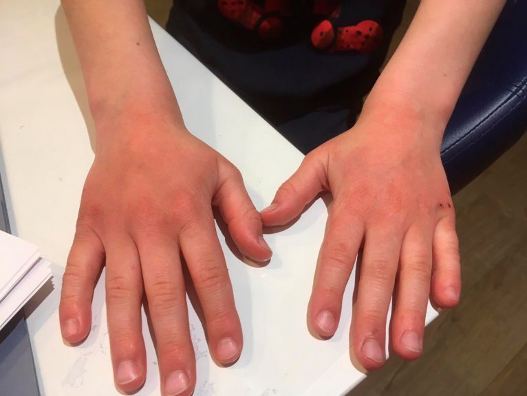 Reacción alérgica manos