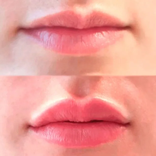 Imagen: Caso de éxito en un tratamiento de relleno de labios con ácido hialurónico - Clínica Estética Castelblanque