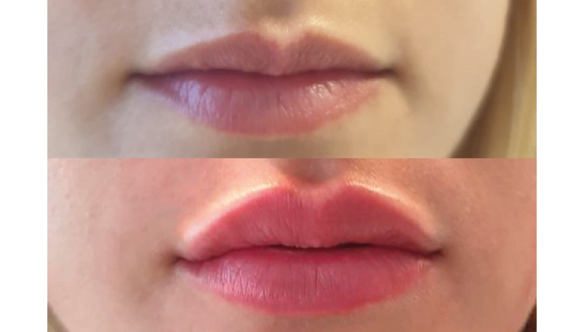 Caso de éxito en relleno de labios con ácido hialurónico – Clínica Estética Castelblanque