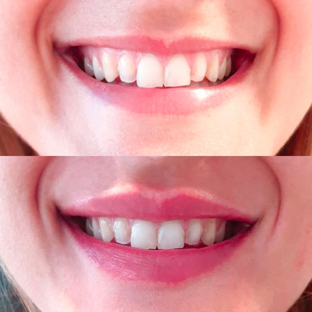 Antes y después de un tratamiento con ácido hialurónico - Clínica Estética Castelblanque