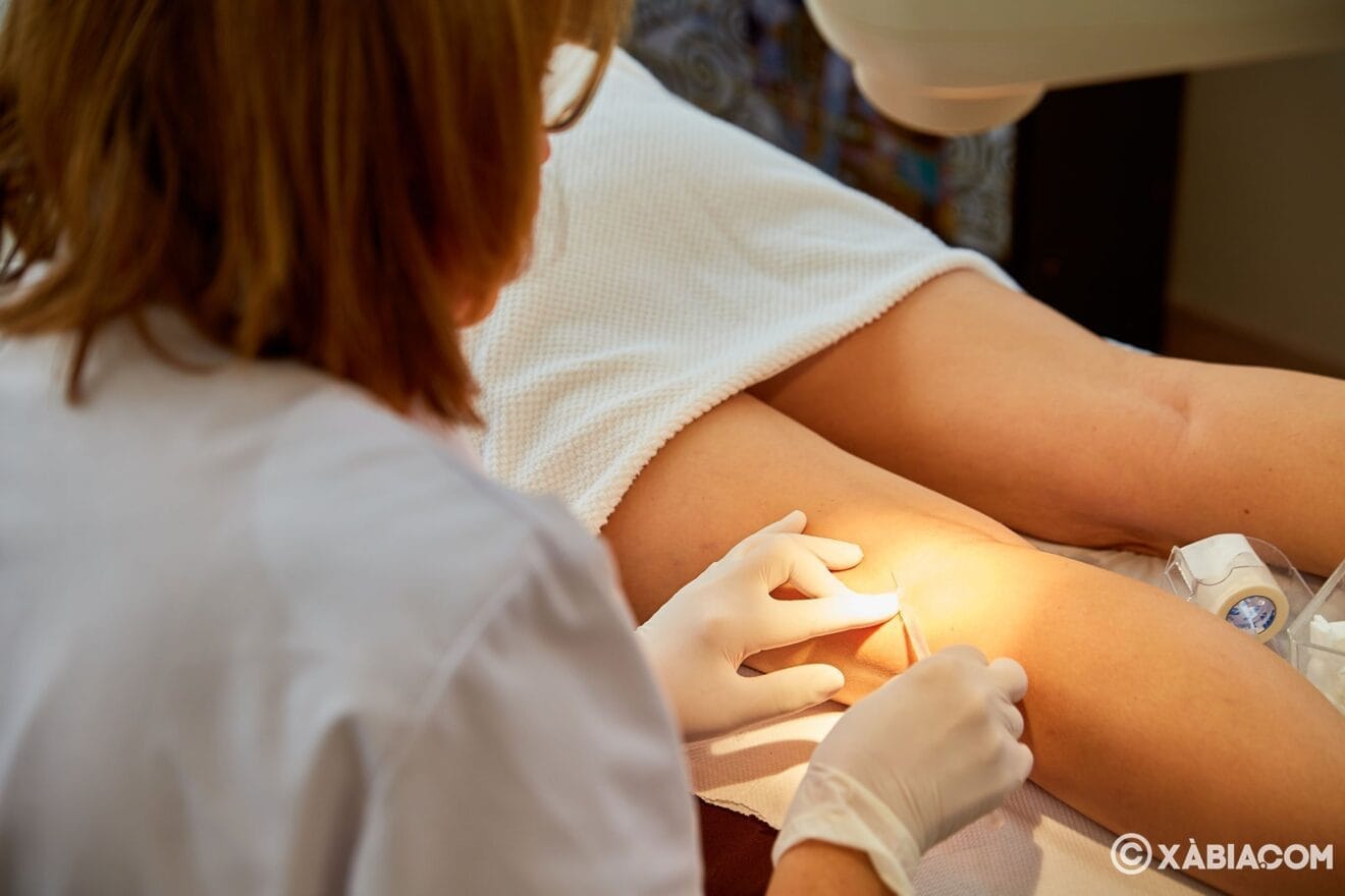 Esclerosis de varices - Policlínica CUME