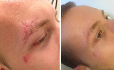 Antes y después del tratamiento de una cicatriz con láser – Clínica Estética Castelblanque