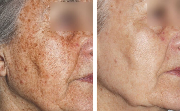 Antes y después del tratamiento de manchas faciales con láser - Clínica Estética Castelblanque