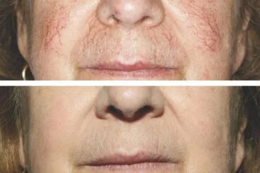 Antes y después del tratamiento de arañas vasculares con láser – Clínica Estética Castelblanque