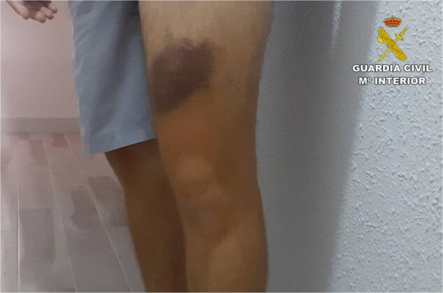 Imagen: Lesiones sufridas de uno de los agentes