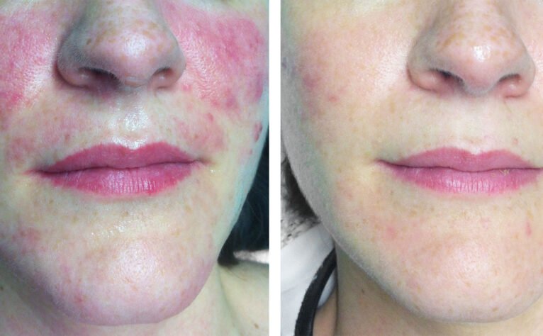 Antes y después de un tratamiento contra las manchas y rojeces en Clínica Estética Castelblanque