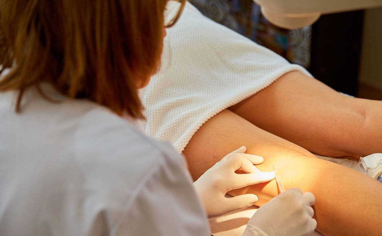 Tratamiento de esclerosis contra las varices - Policlínica CUME