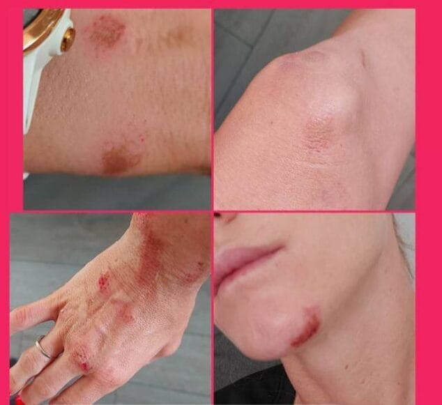 Imagen: Heridas de la ciclista