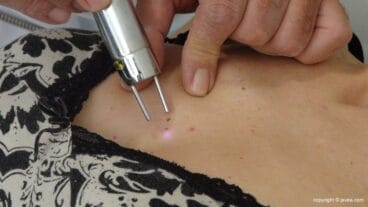 Eliminar manchas rubí – Policlínica CUME