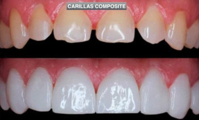 Imagen: Carillas Composite - Clinica Dental Puchol