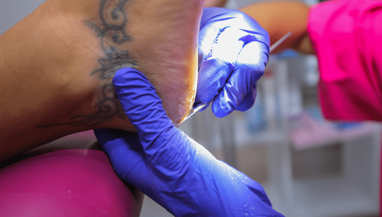 Eliminación de durezas en PodoXabia