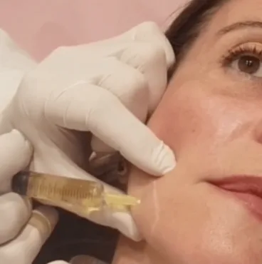 Tratamiento de mesoterapia en Policlínica CUME