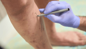 Conoce cuáles son las causas de las varices