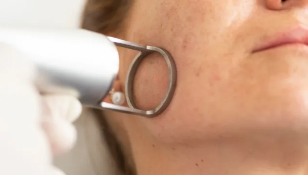 Imagen: Aplicación de láser dermatológico en clínica especializada