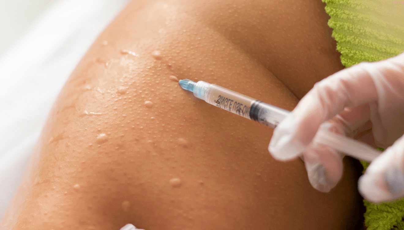 Conoce las ventajas de la Mesoterapia para lucir una piel radiante antes del verano