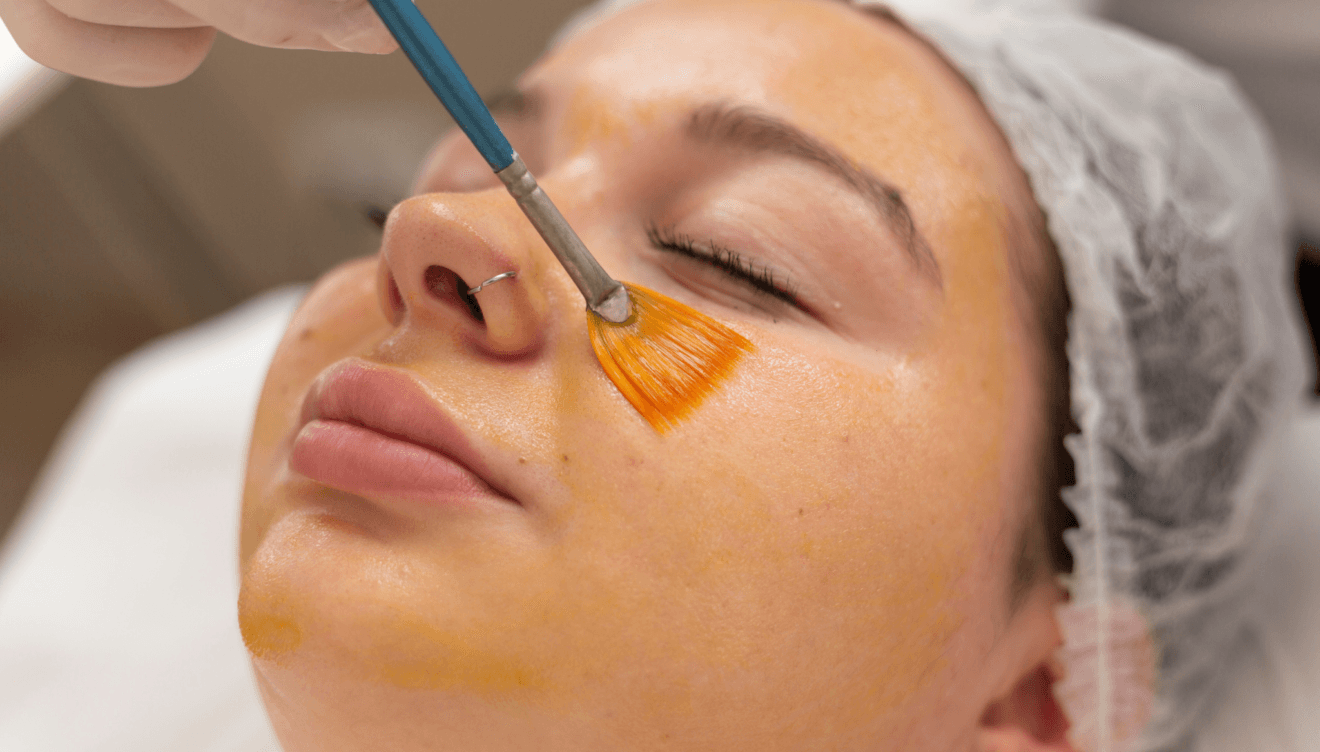 Peeling químico para exfoliación y renovación celular