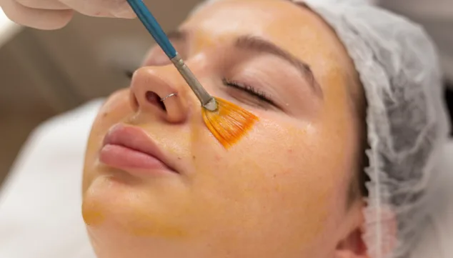 Imagen: Peeling químico para exfoliación y renovación celular