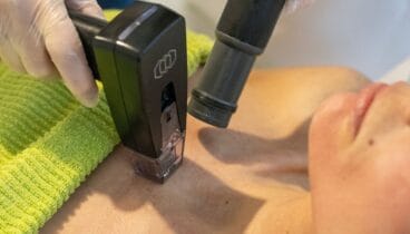 Tratamiento Morpheus 8 para el cuidado de la piel