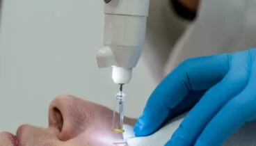 Resultats de blefarolàser per al rejoveniment de la mirada sense cirurgia