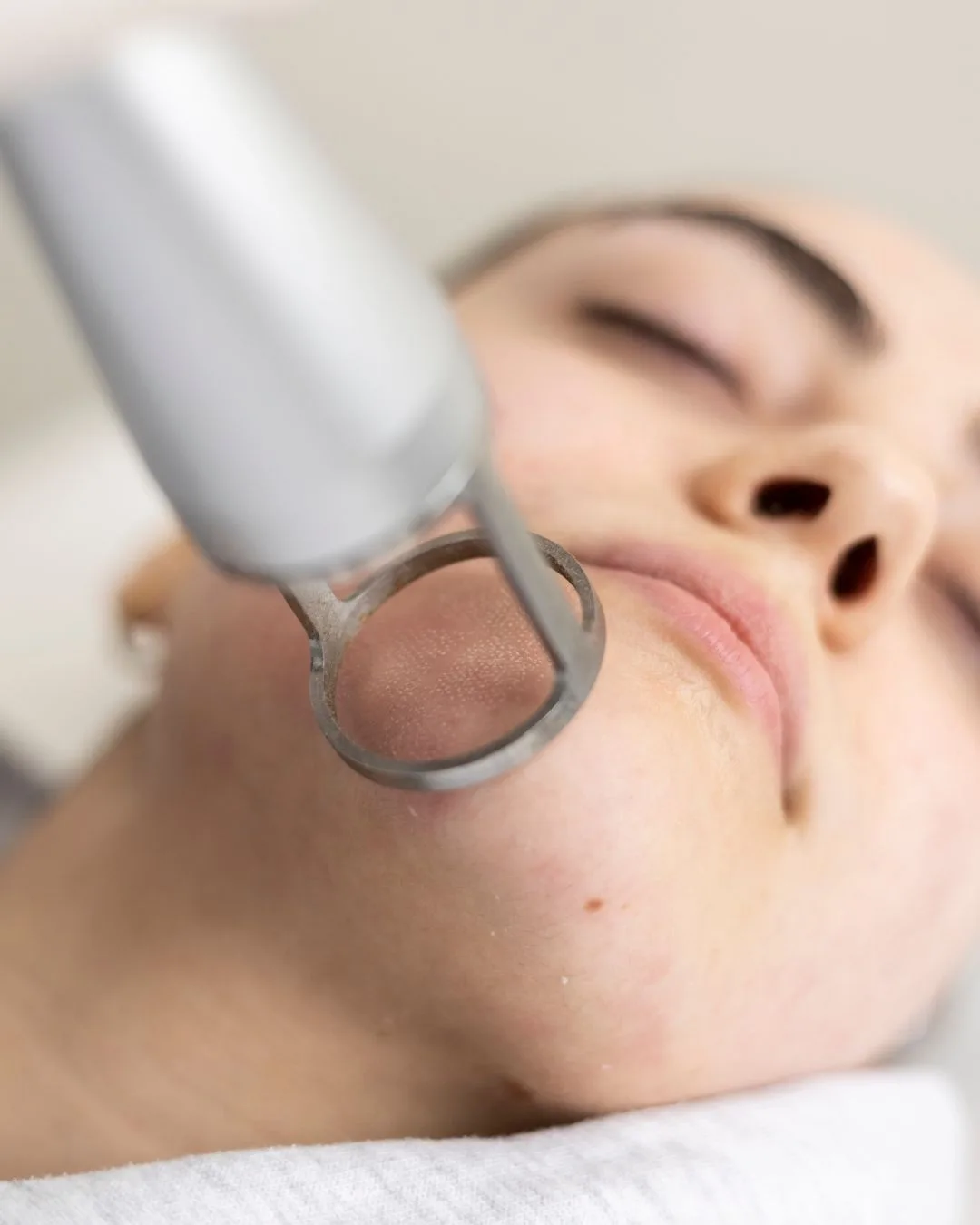 Procedimiento dermatológico profesional para cerrar los poros