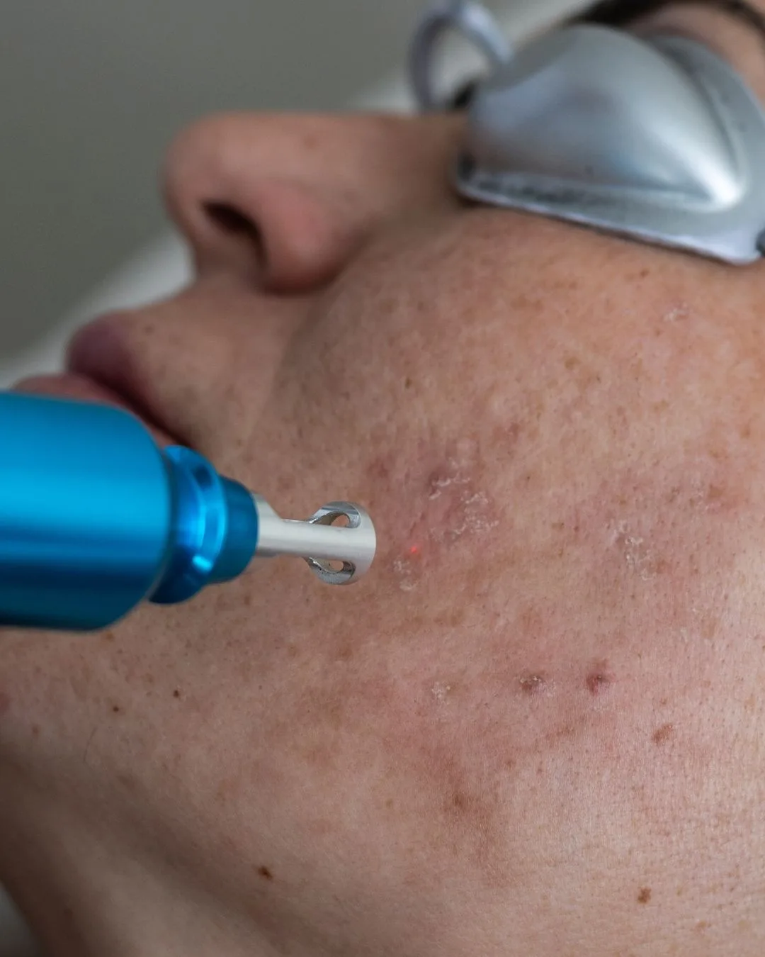 Tecnología láser Hollywood Peeling para una piel radiante