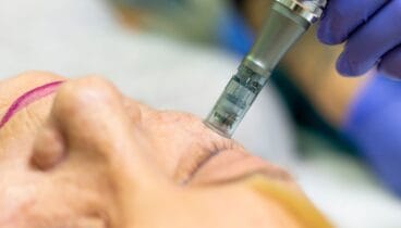 Bioestimulación autóloga